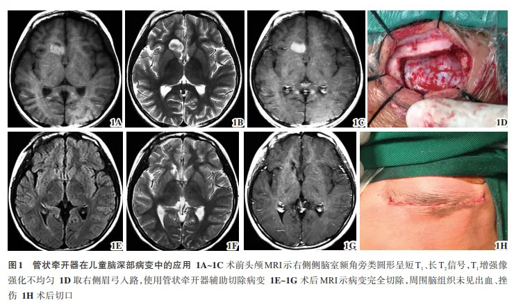 【萊沃醫(yī)療：文獻(xiàn)解讀】一次性使用腦部牽開(kāi)導(dǎo)引導(dǎo)管在兒童腦深部病變的應(yīng)用研究